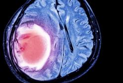 Что очень важно знать про инсульт: предупреждающие сигналы организма (видео)