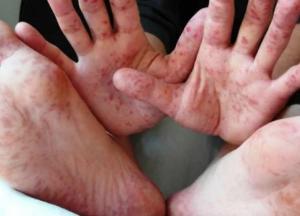 Анализ на антитела к кори: как проверить, защищены ли вы от вируса?