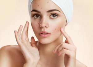 Как избавить кожу от прыщей, когда косметика не помогает