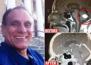 Опухоль головного мозга этого мужчины неожиданно исчезает за день до операции (видео)