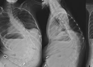 Спинальная мышечная атрофия: беспощадный генетический убийца