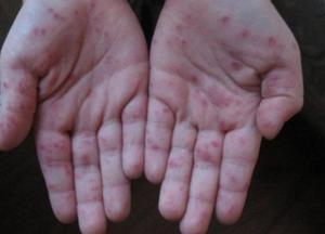 Что нужно знать о вирусе Коксаки: симптомы и как можно себя уберечь