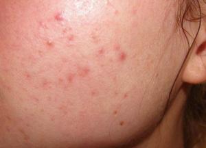 Акне: основные причины появления и с чего начинать лечение