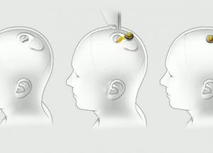 Имплантация чипов в мозг: неозвученные возможности Neuralink