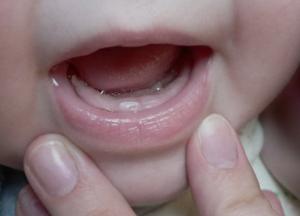 У ребенка долго не растут молочные зубы: что делать