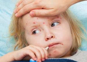 Спалах кору - це тільки початок страшних епідемій в Україні