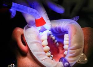 Медики назвали признаки рака ротовой полости