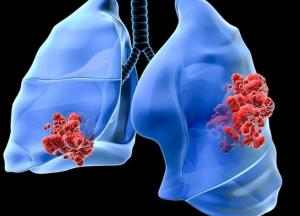 Врачи назвали симптомы рака легких