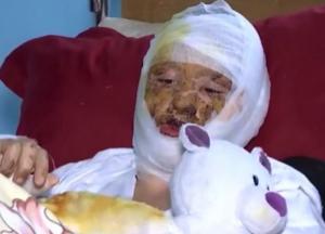 Отец поджег 16-летнюю дочь в Черновцах: выяснились детали зверской расправы (видео)