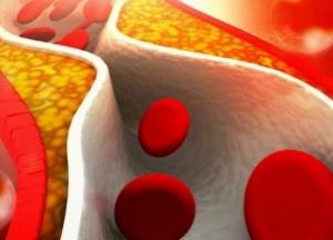 Медики назвали внешние признаки повышенного холестерина
