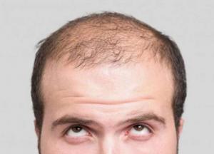Ученые узнали, как предотвратить выпадение волос 