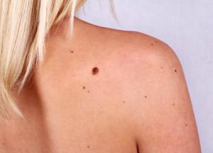 Медики назвали причины развития рака кожи