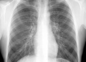 Медики назвали продукты для очищения легких