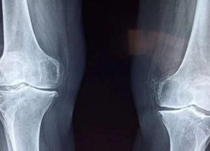 Медики выяснили, как стресс разрушает кости 