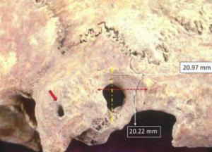 Археологи обнаружили останки людей с необычными хирургическими вмешательствами