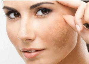 Медики назвали средство, которое поможет справится с прыщами и пигментацией 