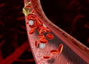 Названы первые признаки тромбоза, которые нельзя игнорировать