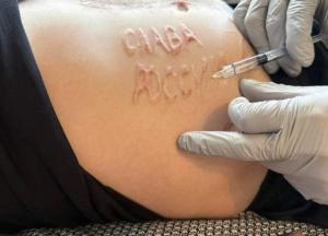 Лікарі почали видаляти з тіла військового напис "Слава России", який йому зробили у полоні (фото)