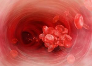 Названы самые распространенные признаки тромбоза