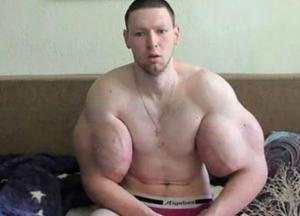 Хирурги удалили у "Руки-базуки" килограммы вазелина из бицепсов (фото)