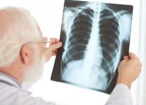 Стала известна причина возникновения рака легких у некурящих людей