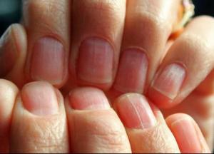 Желтые ногти, белые пятна и другие изменения ногтей, которые могут быть опасными 