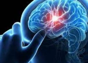 Ученые назвали привычку, повышающую риск инсульта