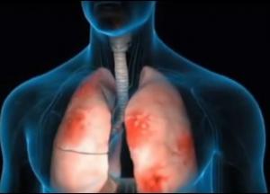 Пневмония. Главные симптомы воспаления легких
