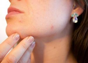 Медики перечислили продукты, которые чаще всего вызывают аллергию