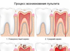 Кариес и другие: 5 самых распространенных зубных болезней