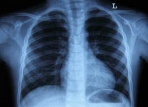 Ученые назвали простой способ избежать рака легких