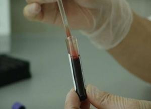 Онкологи назвали ранние симптомы лейкемии