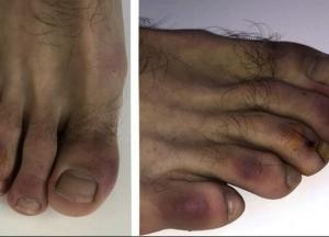 Медики рассказали о новом симптоме COVID-19