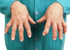 Медики назвали первые симптомы артрита