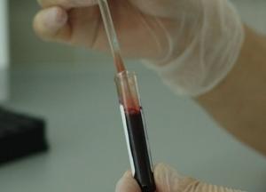 Назван неочевидный признак рака крови