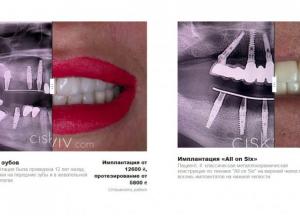 Как избежать осложнений при имплантации зубов