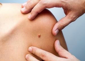 Медики рассказали, как самостоятельно обнаружить меланому