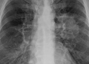 Медики назвали симптомы незаметно развивающегося рака легких