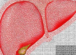 Медики назвали нетипичные симптомы цирроза печени