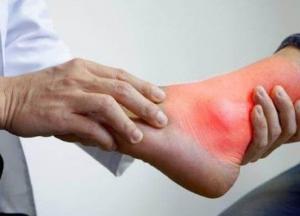 Названы вызывающие подагру продукты