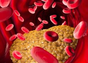 Медики установили, что мешает избавиться от плохого холестерина