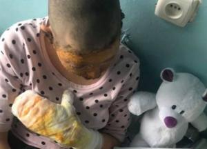 В Черновцах пьяный отец поджег 16-летнюю дочь и едва не угробил ее