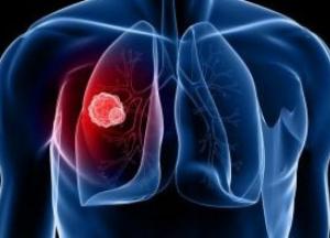 Рак легких: ученые выявили новые признаки смертельной болезни
