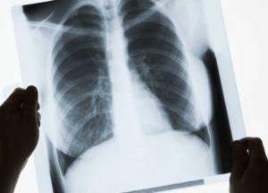 Убивает очень коварно: врач шокировала снимками легких курильщика и больного COVID-19 (фото)