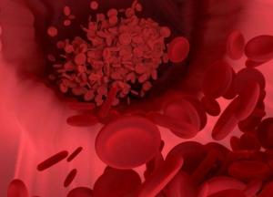 Медики назвали симптомы смертельно опасного тромба