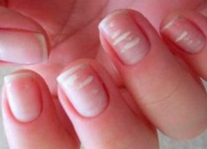 Медики объяснили, о чем свидетельствуют белые пятна на ногтях 