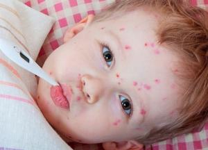 В Україні зафіксували спалах захворюваності на кір