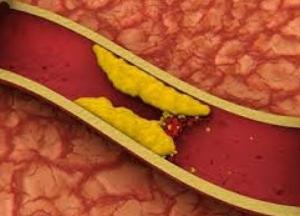 Названы главные симптомы образования тромбов 