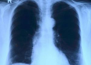 Медики назвали ранний признак рака легких