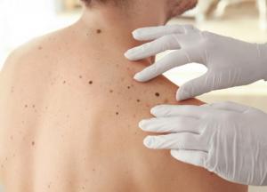 Ученые рассказали о значение родинок на теле у мужчин и женщин